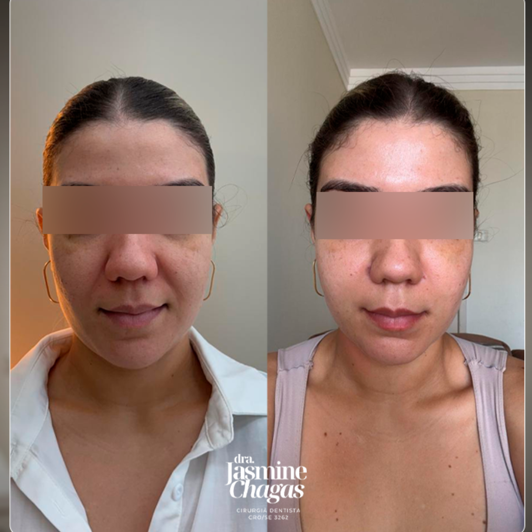 Antes e depois - rejuvenescimento facial