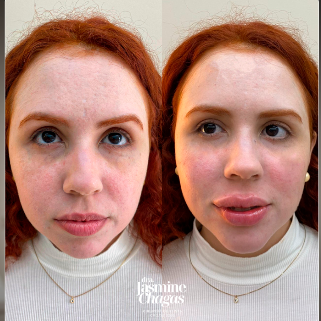 Antes e depois - tratamento de flacidez no pescoço