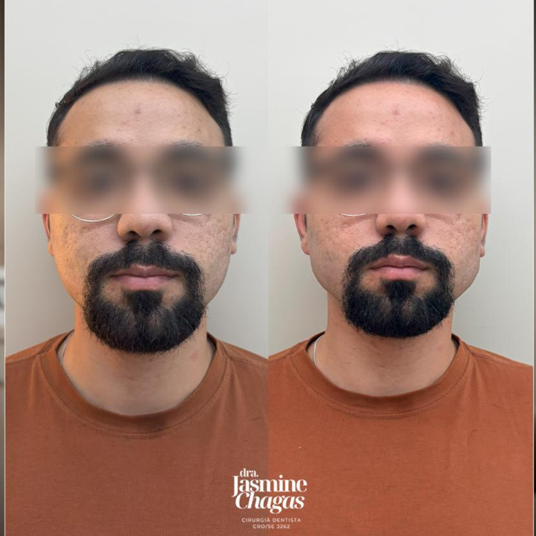 Antes e depois - preenchimento de mandíbula